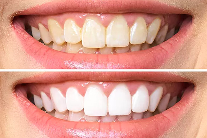 blanqueamiento-dental