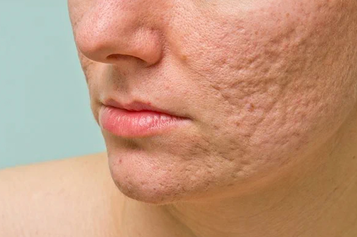 cicatrices-acne